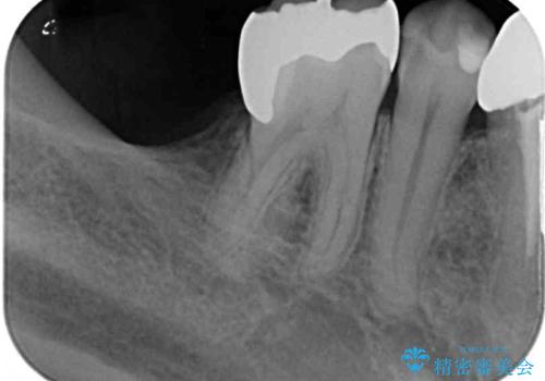 欠損と治療途中の奥歯 インプラント治療と補綴治療の治療前