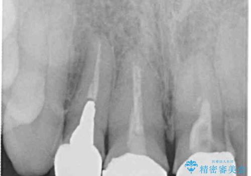 前歯の黒い縁を綺麗にしたい 前歯のオールセラミックの治療前
