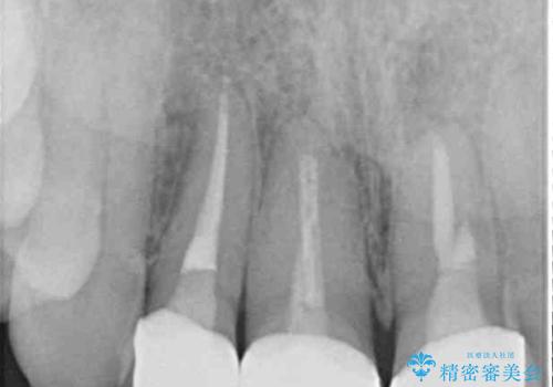 前歯の黒い縁を綺麗にしたい 前歯のオールセラミックの治療後