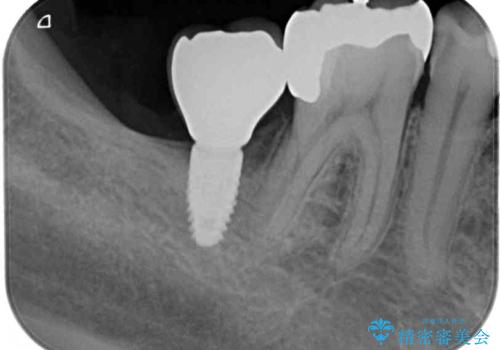 欠損と治療途中の奥歯 インプラント治療と補綴治療の治療後