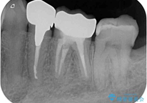 欠損と治療途中の奥歯 インプラント治療と補綴治療の治療後