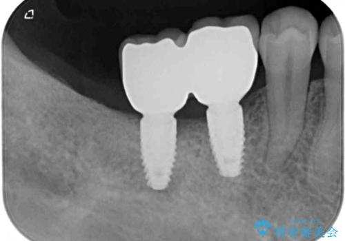 不正咬合で抜歯となった奥歯　インプラントによる咬合回復の治療後