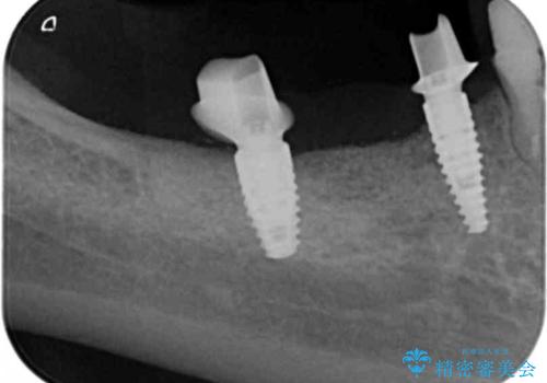 狭小な歯槽骨に対するインプラント治療の治療中