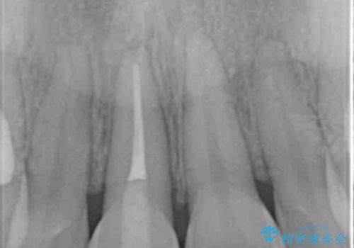 前歯の変色　打撲により失活した前歯の根管・セラミック治療の治療中