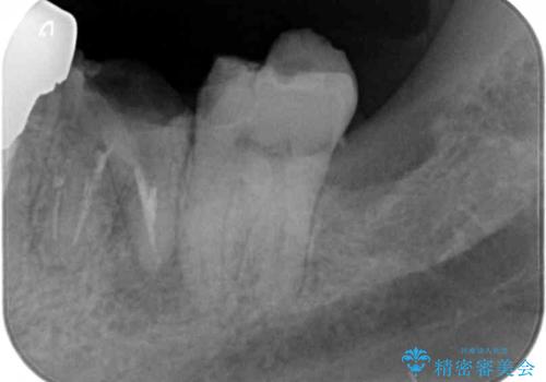 欠損と治療途中の奥歯 インプラント治療と補綴治療の治療前