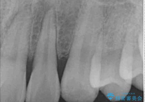 転んで前歯が欠けてぐらぐらに 歯の神経も死んでしまったの治療前