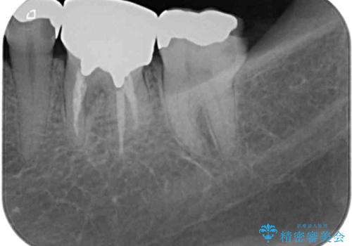 銀歯の下のむし歯で欠けてしまった歯 オールセラミッククラウン治療の治療前