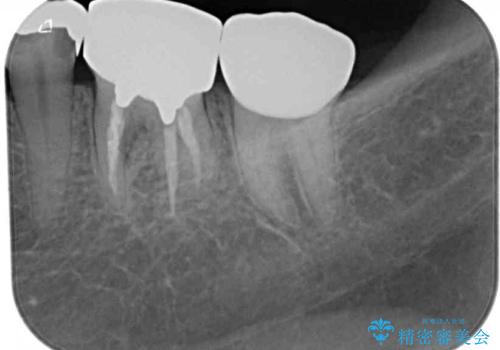 銀歯の下のむし歯で欠けてしまった歯 オールセラミッククラウン治療の治療後