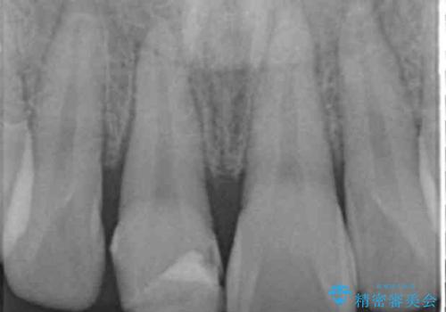 転んで前歯が欠けてぐらぐらに 歯の神経も死んでしまったの治療前