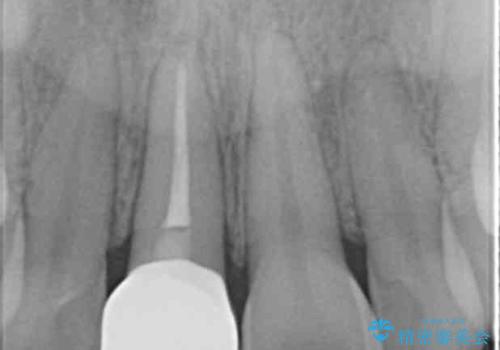 前歯の変色　打撲により失活した前歯の根管・セラミック治療の治療後