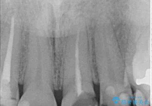 大きなむし歯と欠損をセラミックに 部分矯正を併用した総合歯科治療の治療前