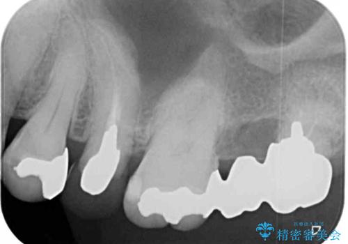 目立つ銀歯と露出した歯根　セラミックでの審美歯科治療の治療前