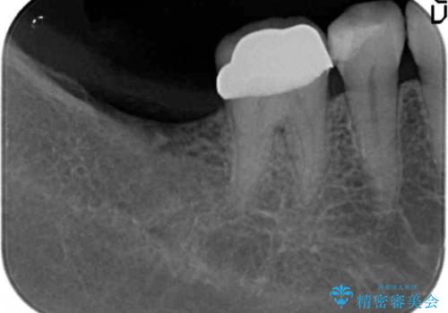 伸びてしまった奥歯、咬合平面を揃えたインプラント治療の治療前