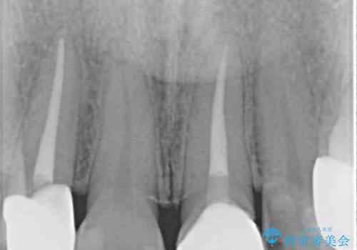 大きなむし歯と欠損をセラミックに 部分矯正を併用した総合歯科治療の治療後