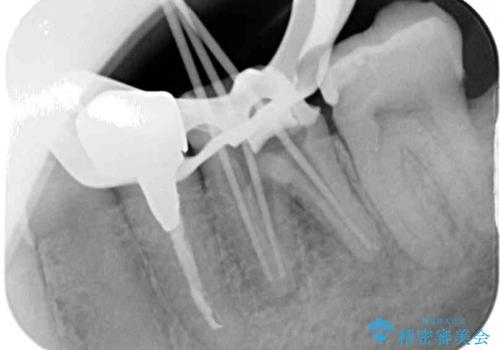 欠損と治療途中の奥歯 インプラント治療と補綴治療の治療中