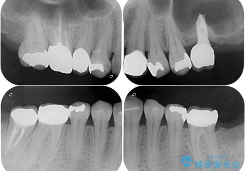 大きなむし歯と欠損をセラミックに 部分矯正を併用した総合歯科治療の治療後