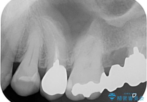 目立つ銀歯と露出した歯根 セラミックでの審美歯科治療の治療後