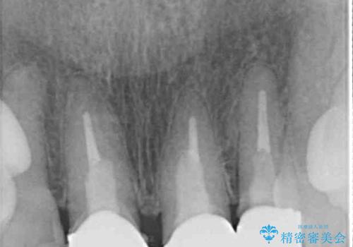 前歯を明るくしたい　前歯のオールセラミッククラウン治療の治療後