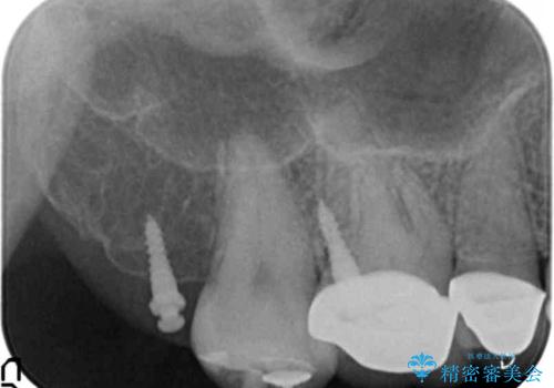 伸びてしまった奥歯、咬合平面を揃えたインプラント治療の治療中