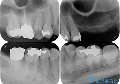 大きなむし歯と欠損をセラミックに 部分矯正を併用した総合歯科治療の治療前