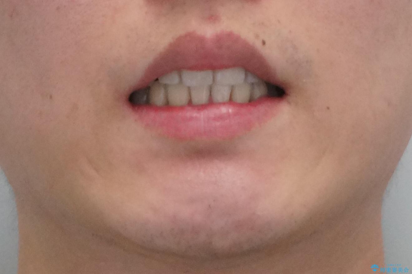 前歯のすき間、犬歯の異所萌出 乳歯を抜かずに矯正の治療後(顔貌)