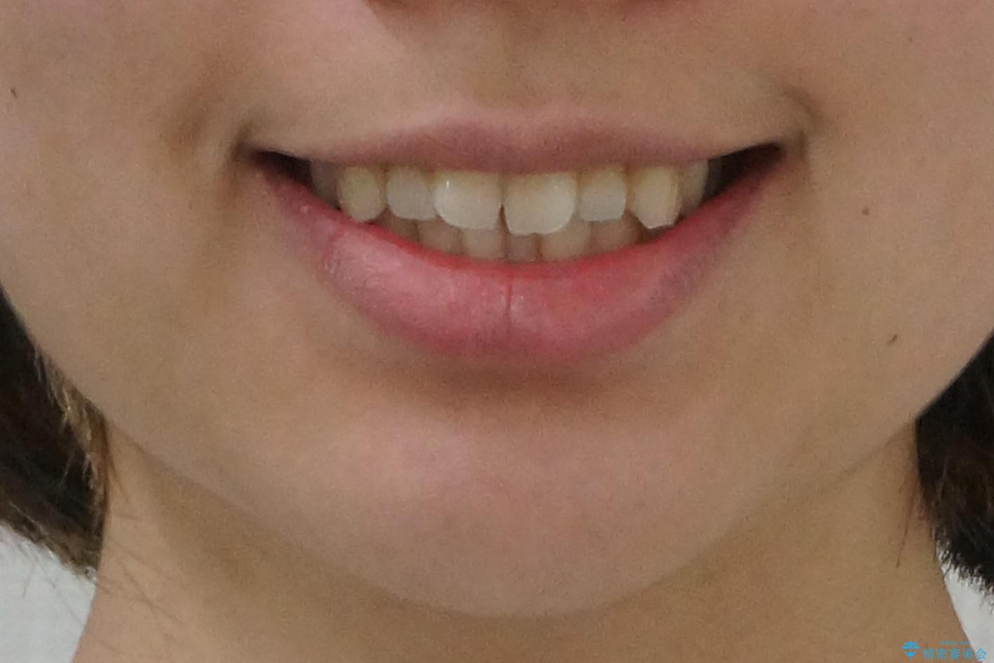 インビザライン モニター治療 前歯のねじれをまっすぐに の治療前(顔貌)