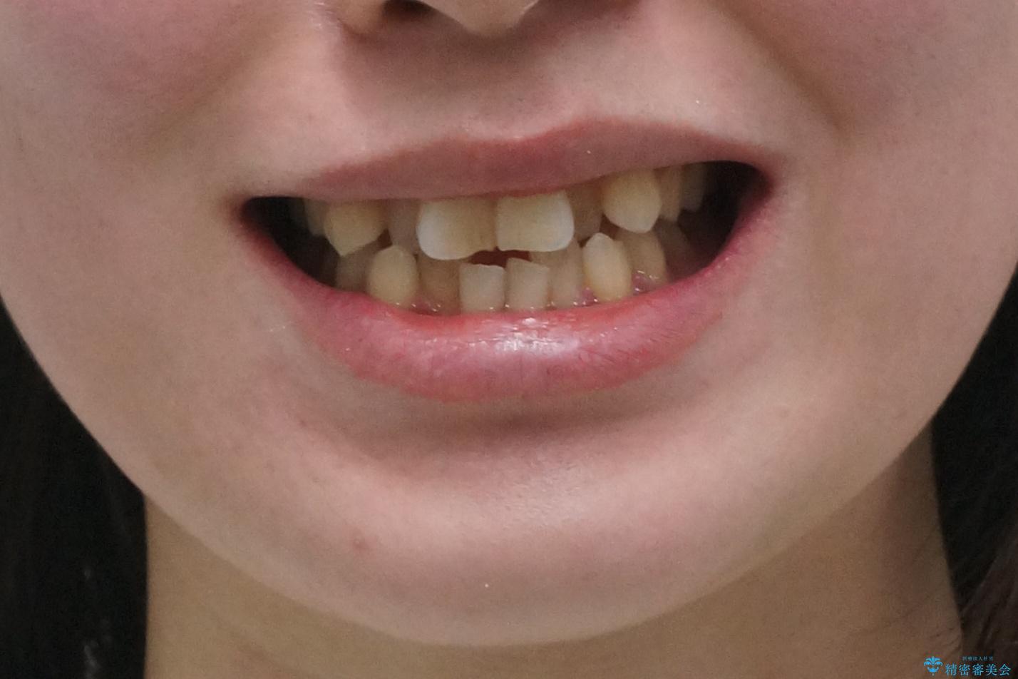 前歯のがたつき、中に入ってしまっている 部分矯正で低予算での治療前(顔貌)