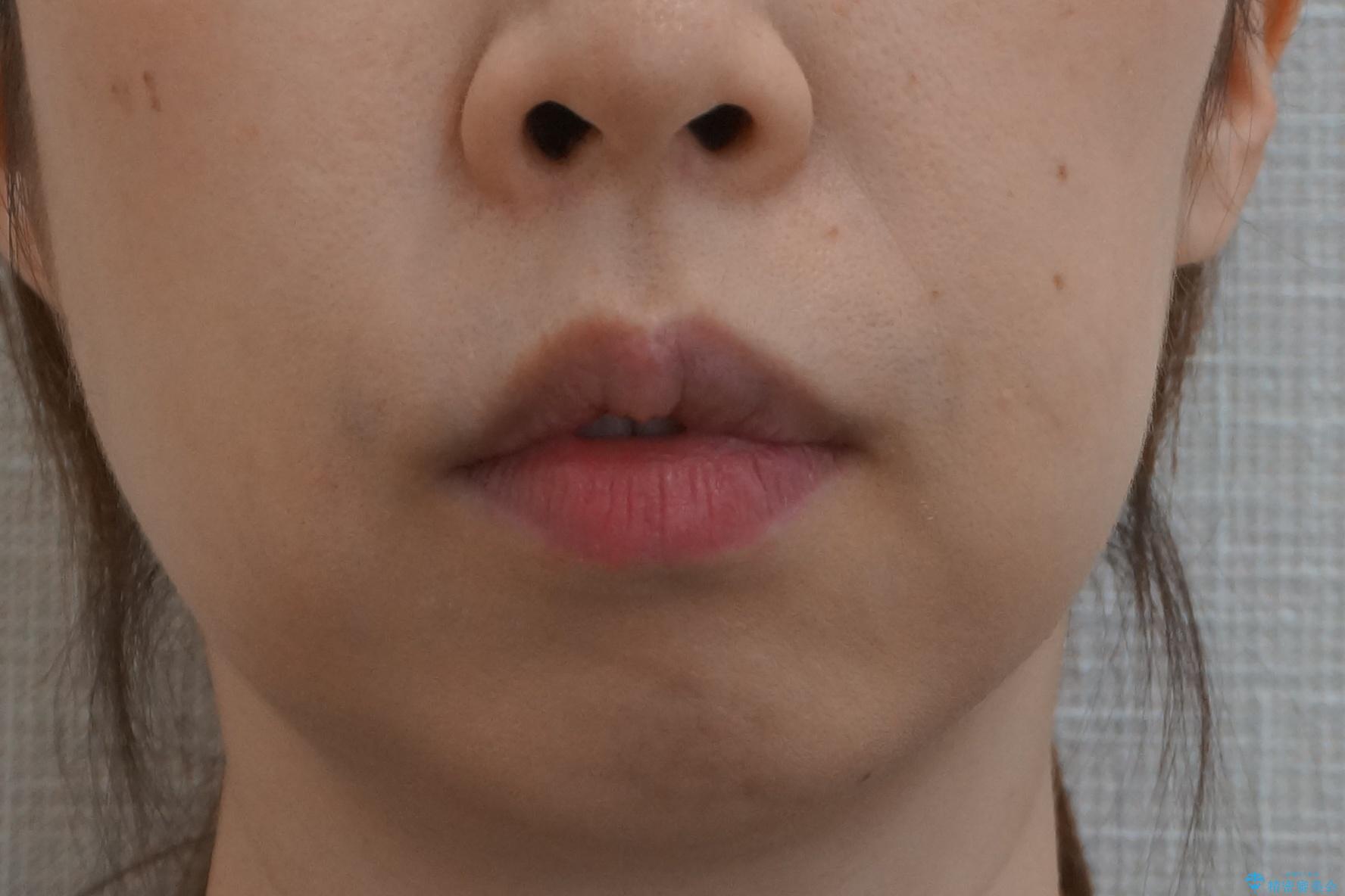 他院で3年以上かかると言われた八重歯を半年できれいに の治療前(顔貌)