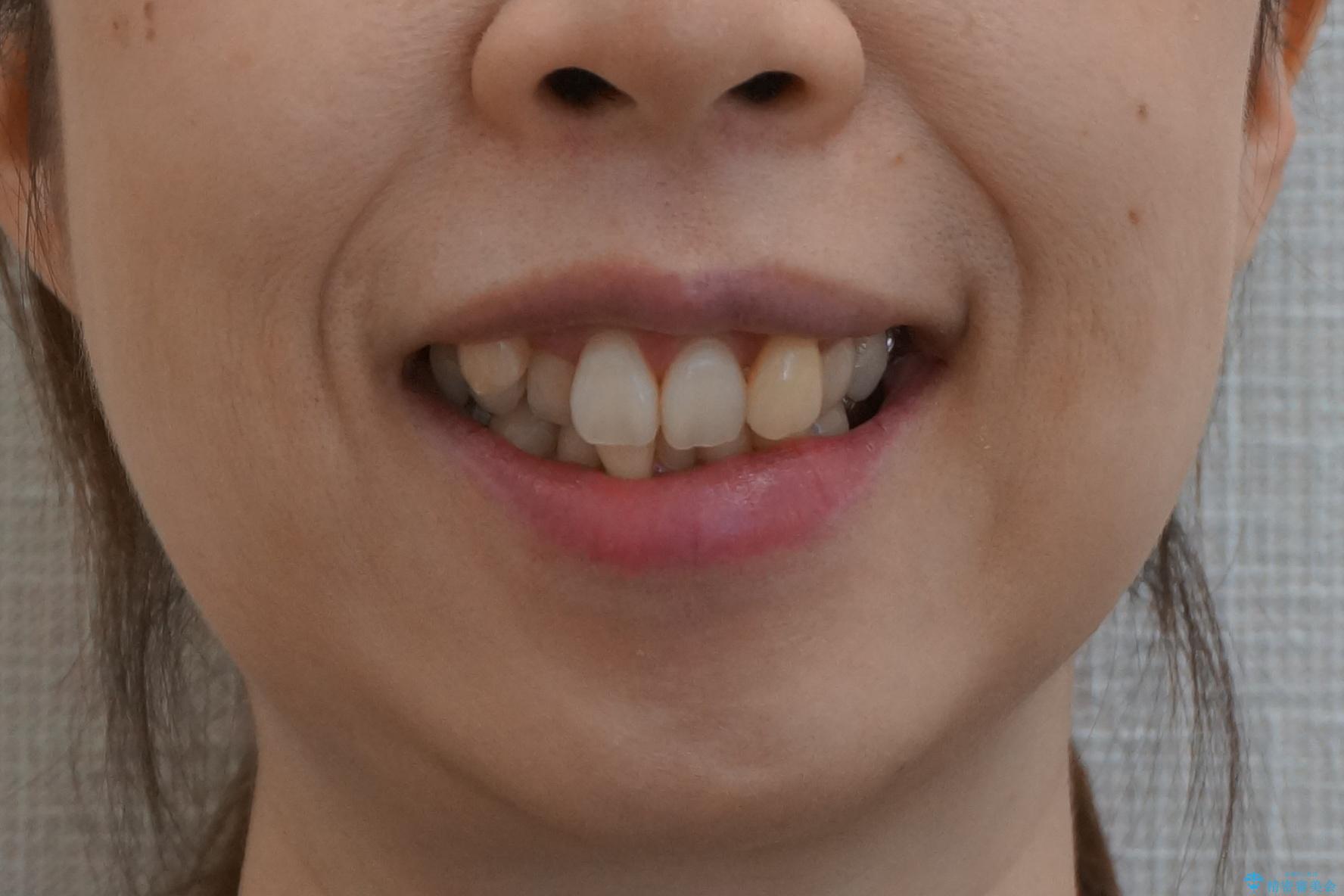 他院で3年以上かかると言われた八重歯を半年できれいに の治療前(顔貌)