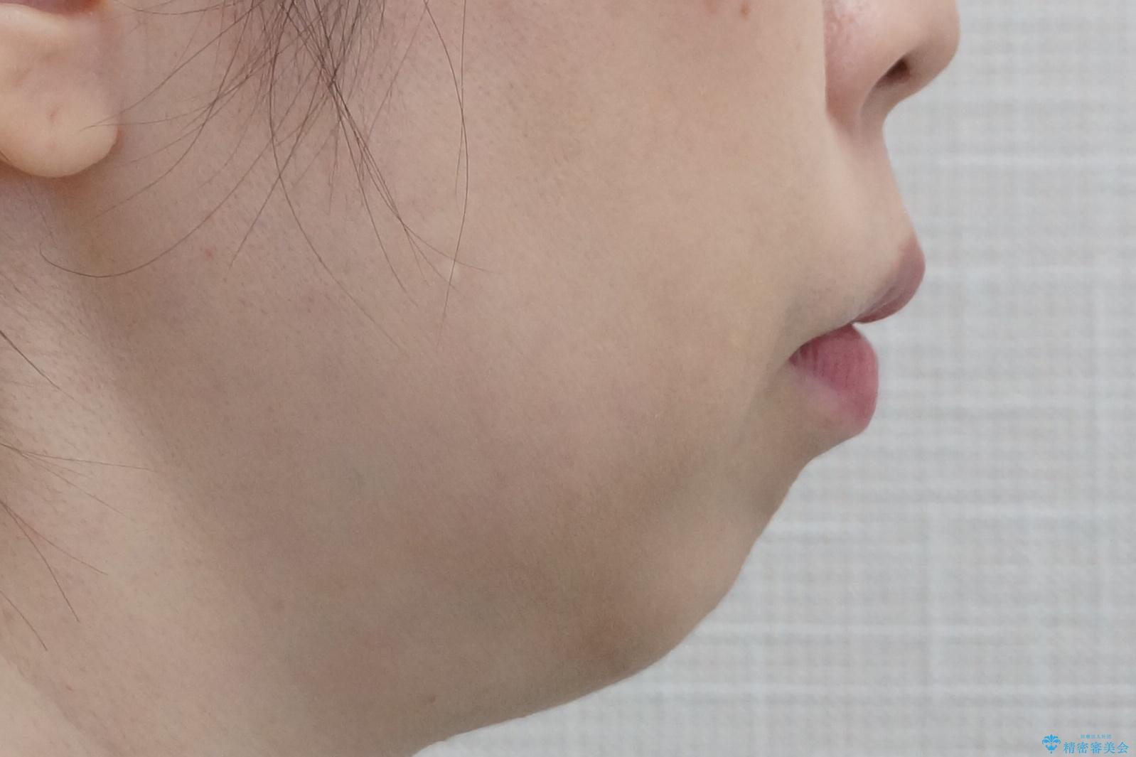 他院で3年以上かかると言われた八重歯を半年できれいに の治療前(顔貌)