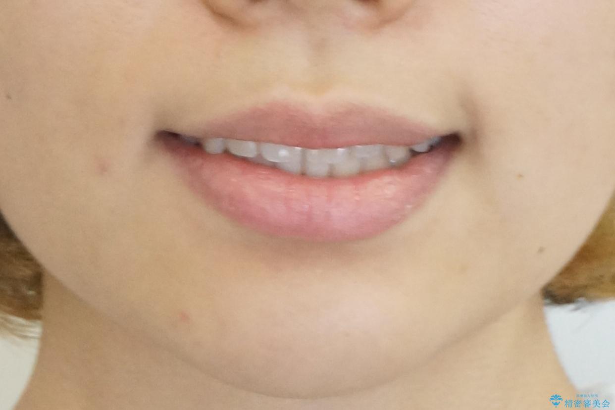 インビザライン モニター治療 前歯のねじれをまっすぐに の治療後(顔貌)
