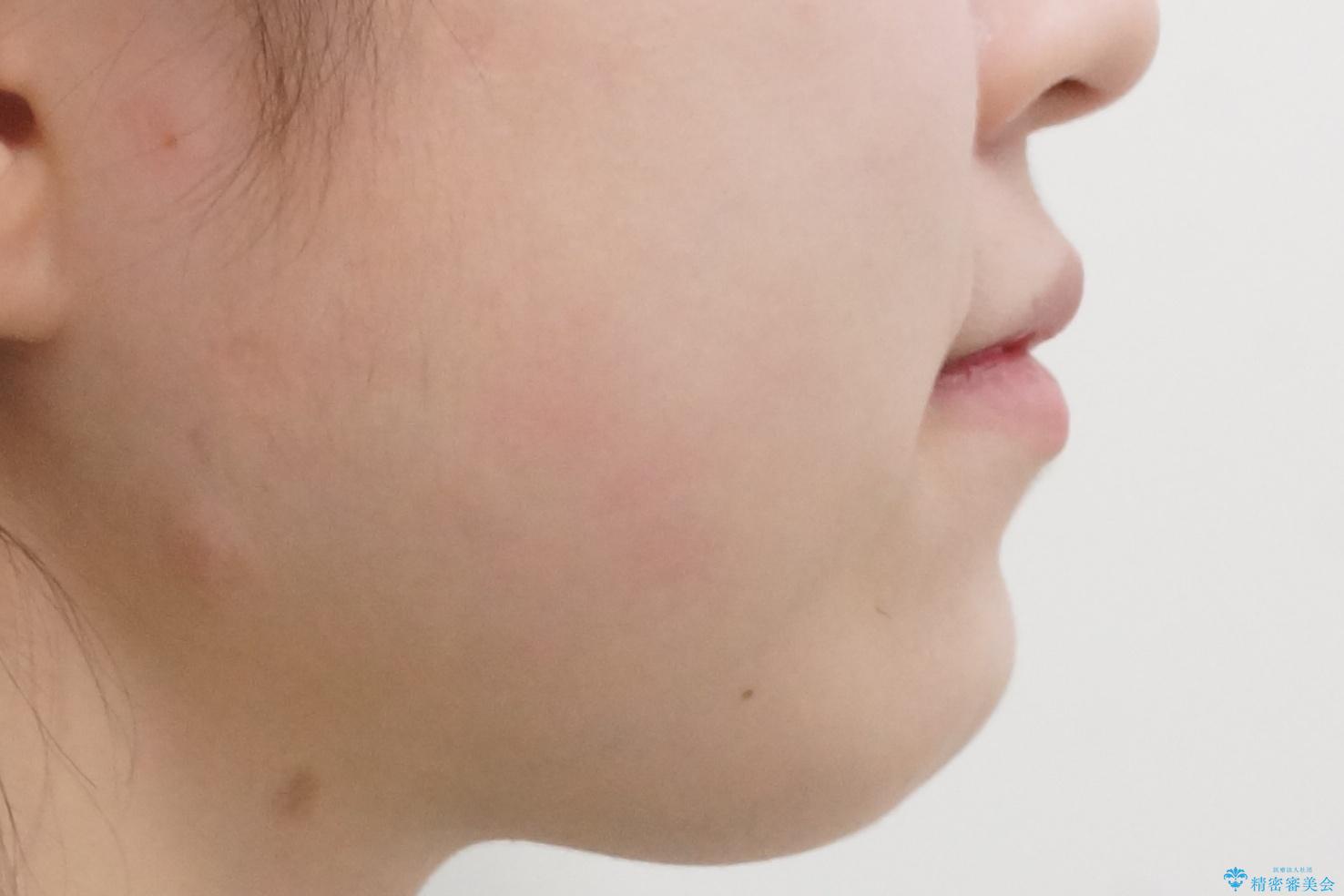 人の印象は歯並びから! 実は…美容医療より効果抜群!! コスパ重視ならすきっ歯の矯正治療の治療前(顔貌)