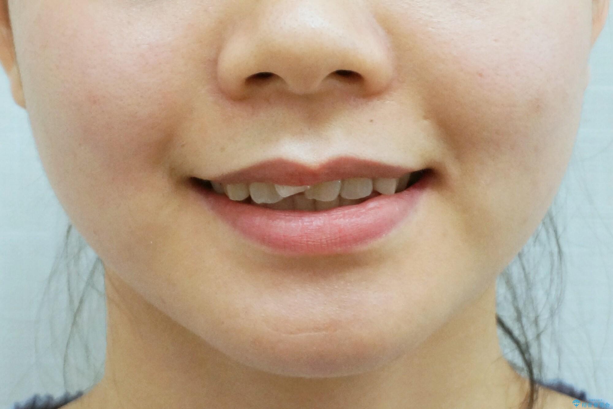 前歯を引っ込めたい 歯を抜かずにマウスピースでの治療前(顔貌)