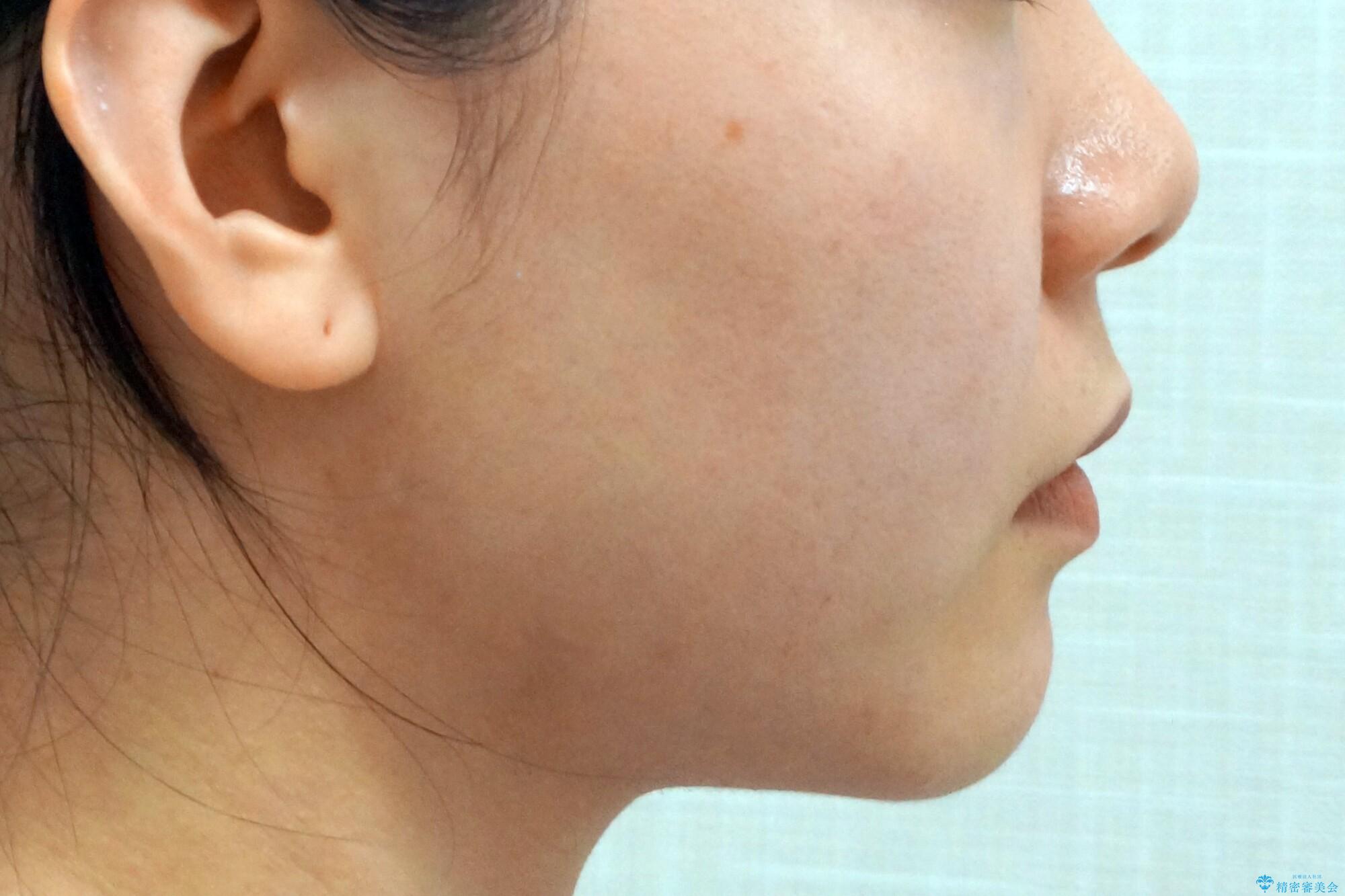 前歯を引っ込めたい 歯を抜かずにマウスピースでの治療前(顔貌)