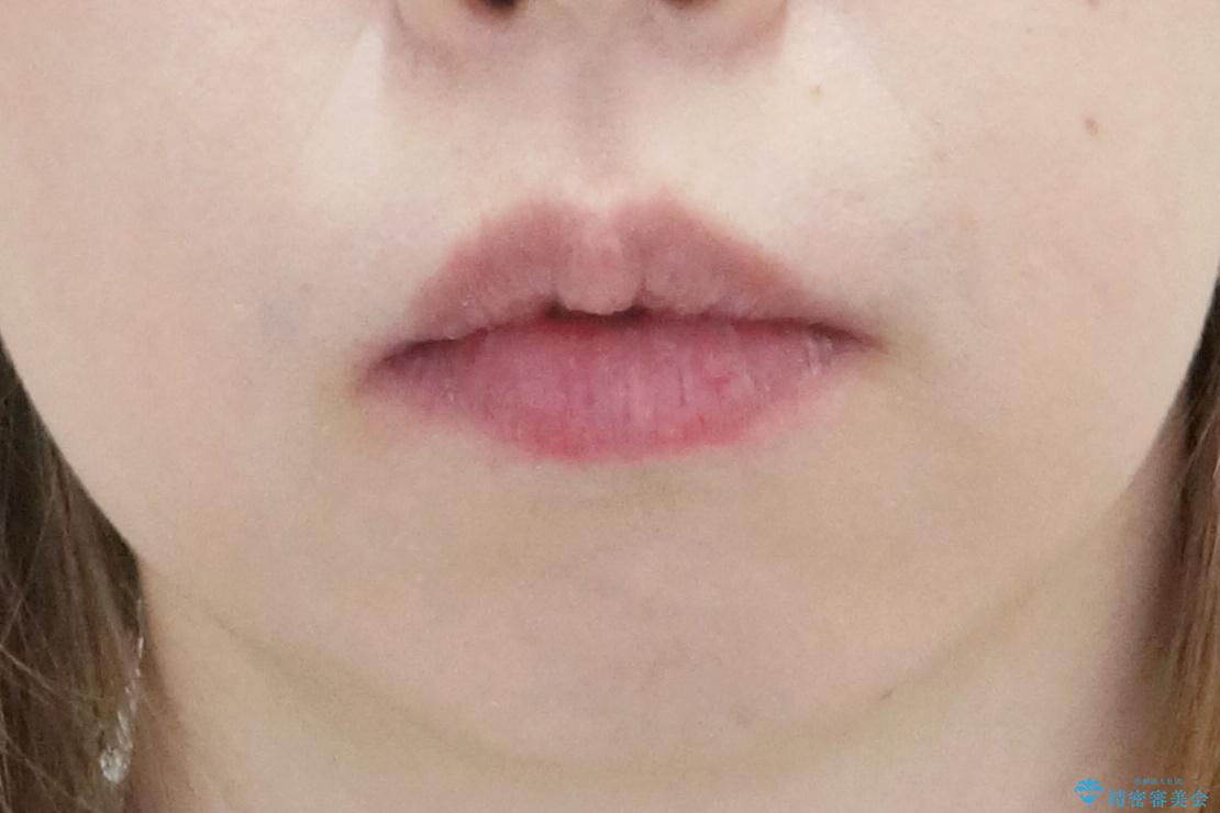 他院で3年以上かかると言われた八重歯を半年できれいに の治療後(顔貌)