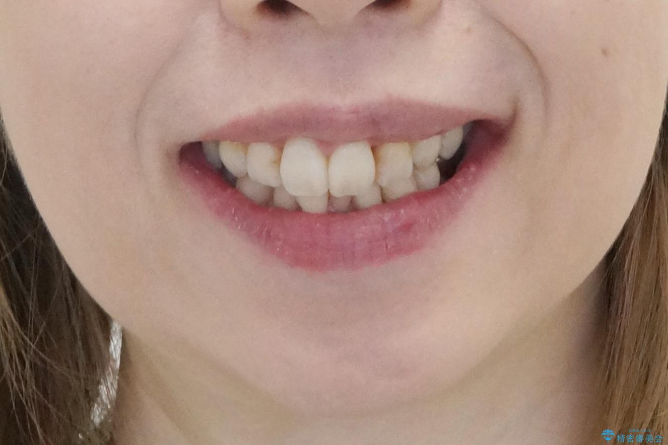 他院で3年以上かかると言われた八重歯を半年できれいに の治療後(顔貌)