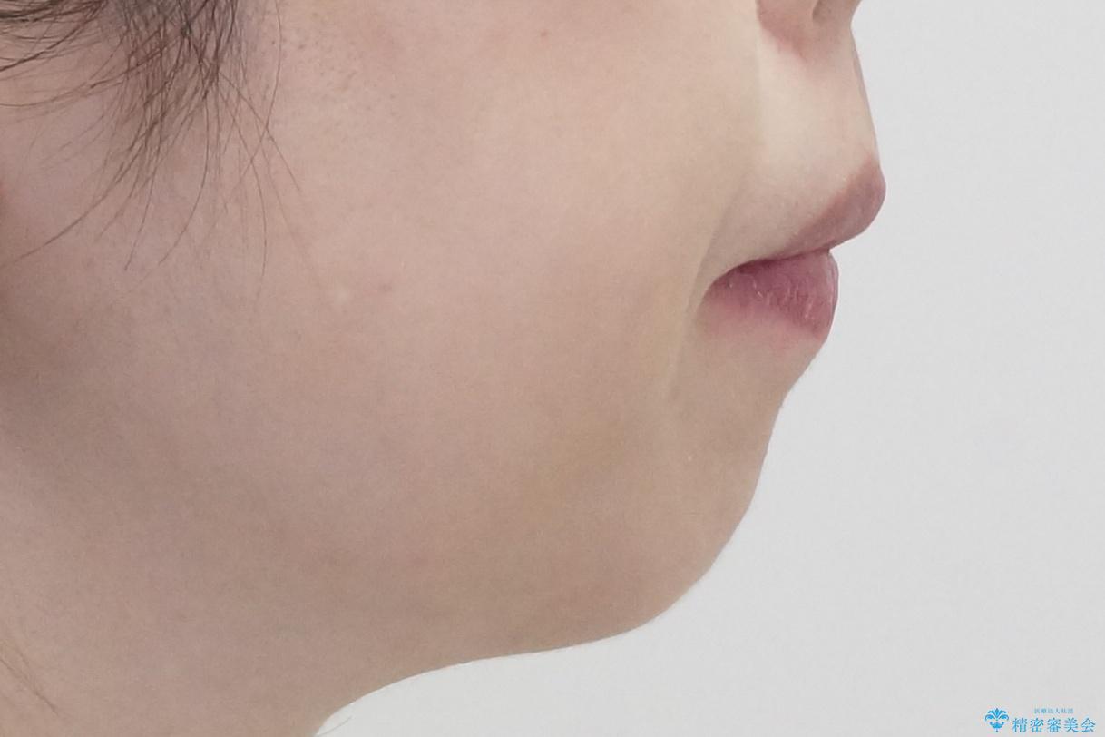 他院で3年以上かかると言われた八重歯を半年できれいに の治療後(顔貌)