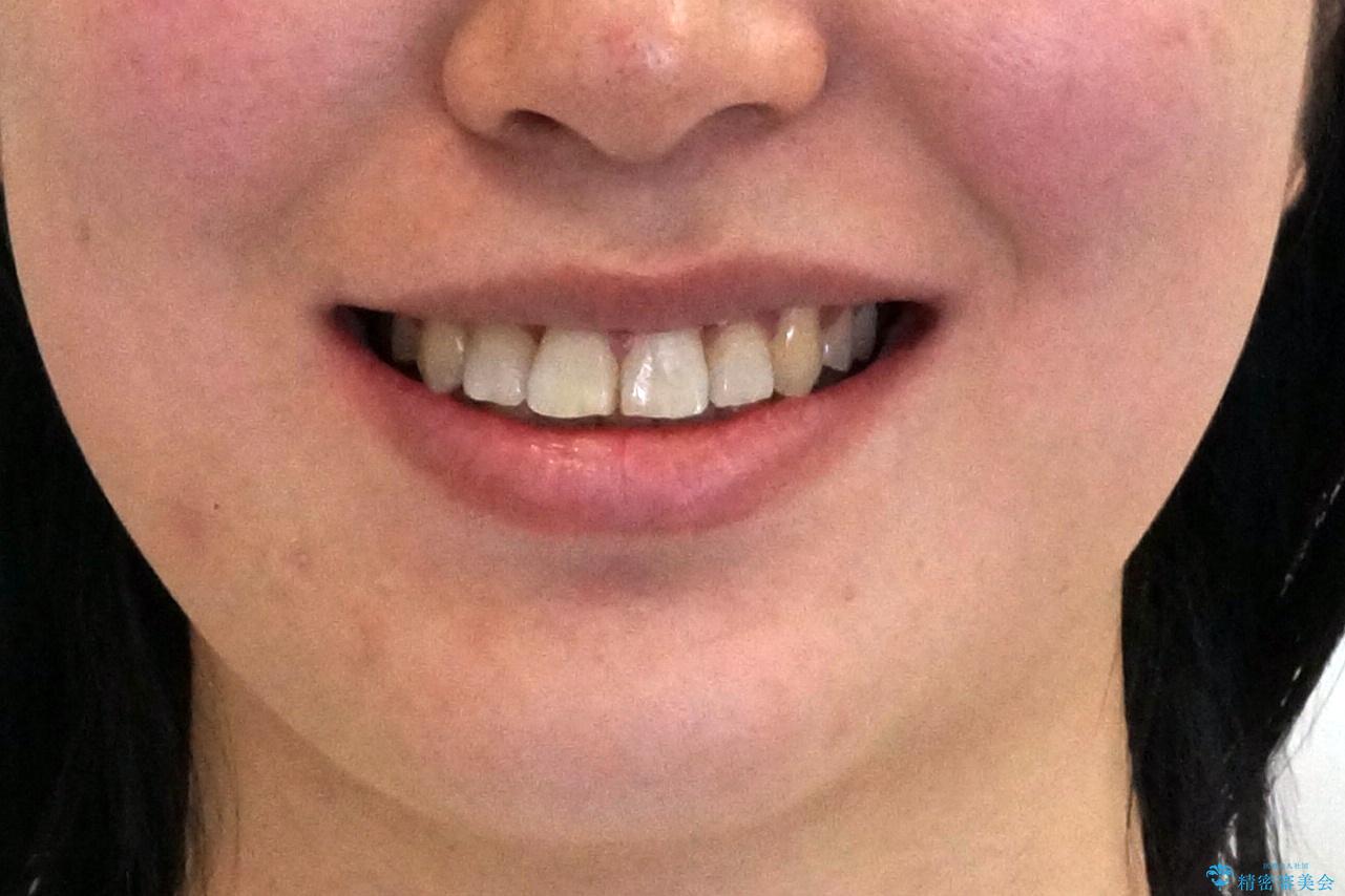 前歯のがたつき、中に入ってしまっている 部分矯正で低予算での治療後(顔貌)