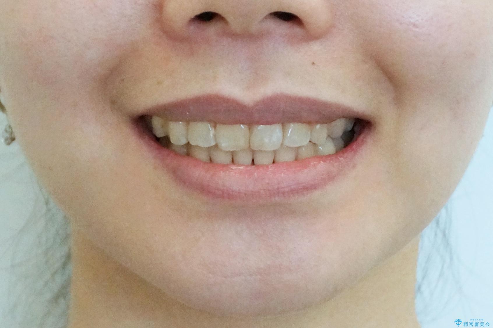 前歯を引っ込めたい 歯を抜かずにマウスピースでの治療後(顔貌)