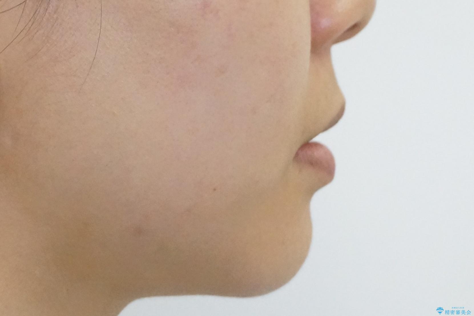 前歯を引っ込めたい 歯を抜かずにマウスピースでの治療後(顔貌)