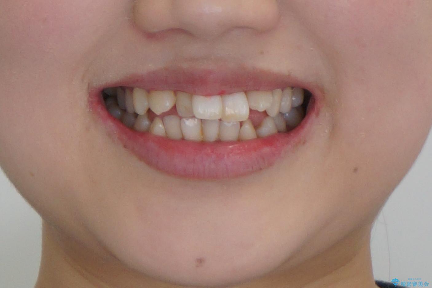 難症例 奥歯がかみ合っていない 歯並び矯正で別人にの治療前(顔貌)