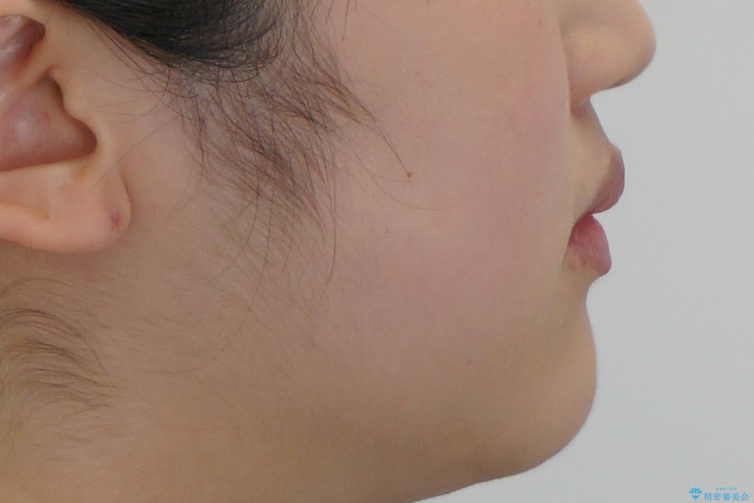 難症例 奥歯がかみ合っていない 歯並び矯正で別人にの治療前(顔貌)