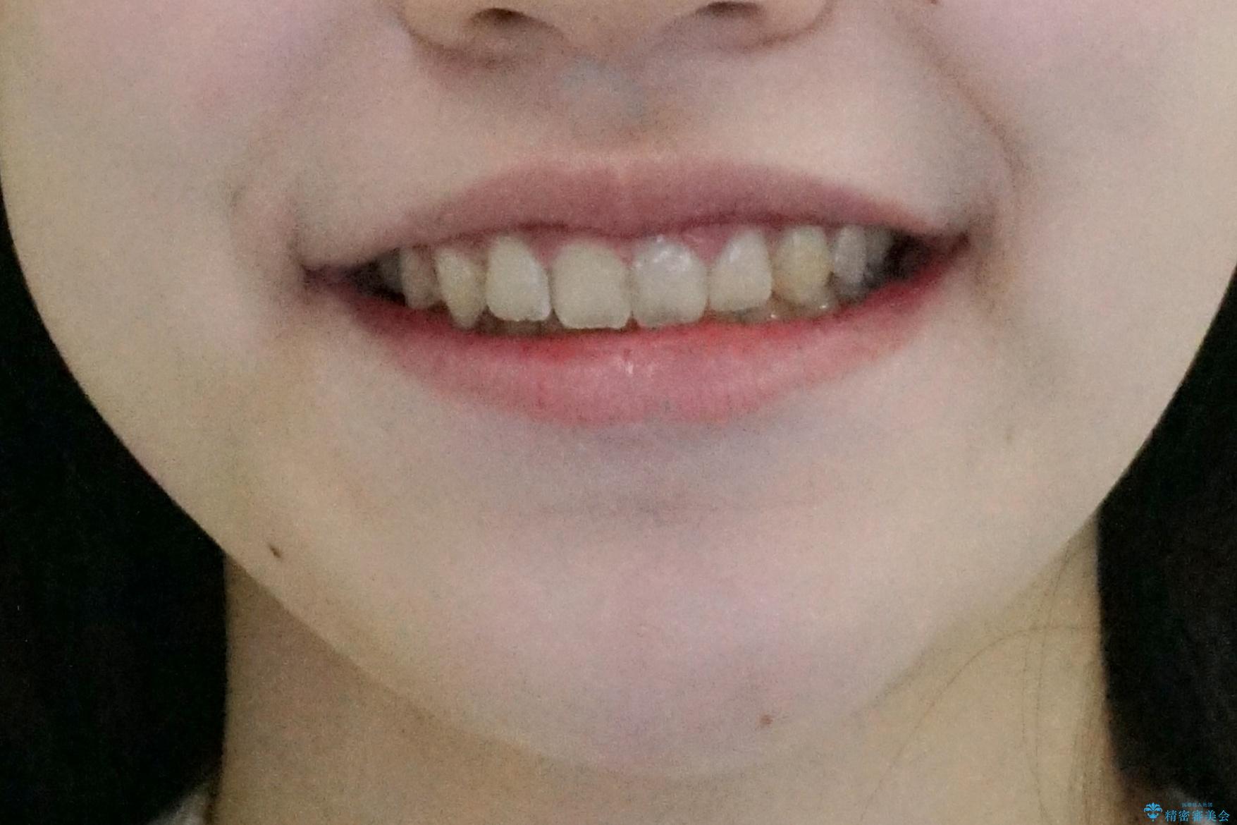人の印象は歯並びから! 実は…美容医療より効果抜群!! コスパ重視ならすきっ歯の矯正治療の治療後(顔貌)