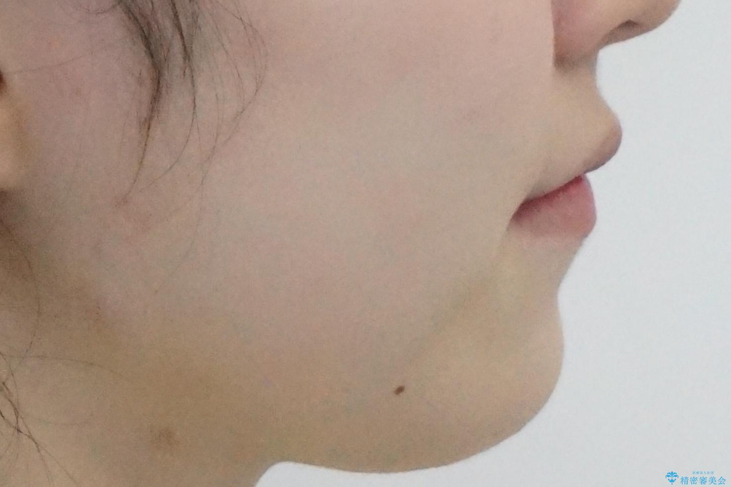 人の印象は歯並びから! 実は…美容医療より効果抜群!! コスパ重視ならすきっ歯の矯正治療の治療後(顔貌)