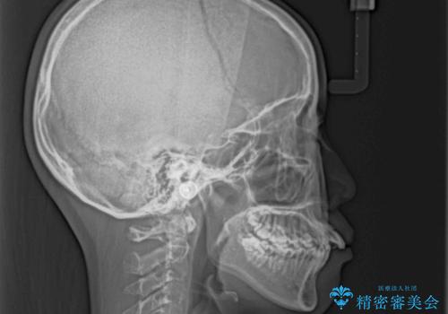唇からはみ出るほど飛び出した前歯 ワイヤー装置による抜歯矯正の治療前