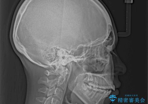 前に出ている上顎 抜歯矯正で唇を閉じやすくの治療前