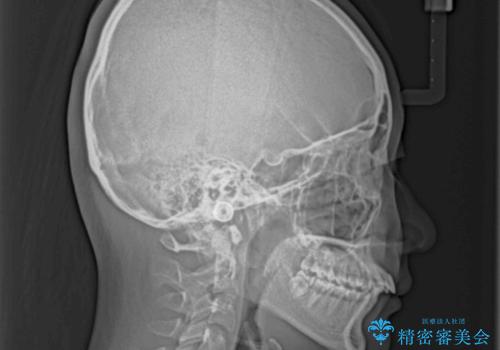 前歯が2本ない ワイヤー装置での抜歯矯正の治療前