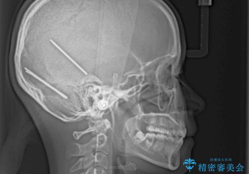 【モニター】口が閉じにくい 膨らんだ口元を抜歯矯正ですっきりとの治療後