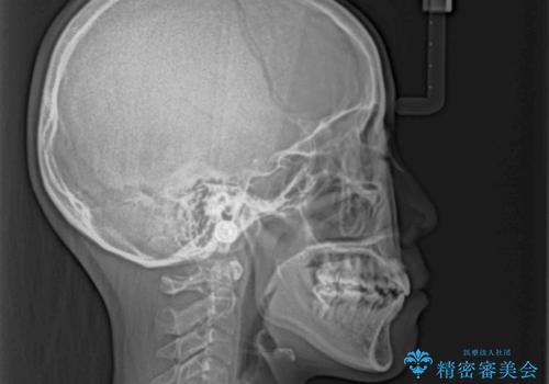 唇からはみ出るほど飛び出した前歯 ワイヤー装置による抜歯矯正の治療後