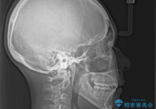 前に出ている上顎 抜歯矯正で唇を閉じやすくの治療後